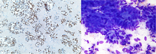 Lung Adenocarcinoma 1.png
